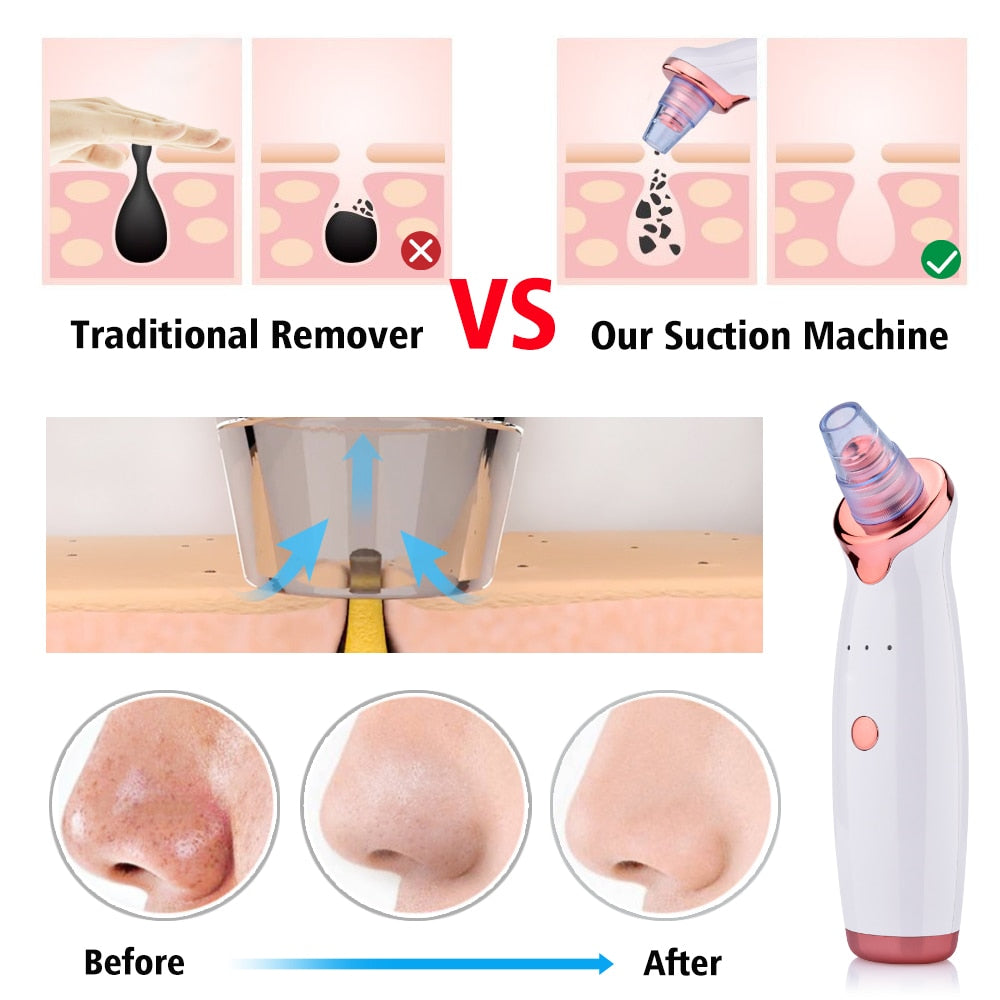 Electric Blackhead Remover & Pore Vacuum Cleansing Device (view 8)